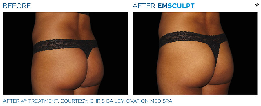 Before and After Photo of Butt Lift Treatment in Merrimack